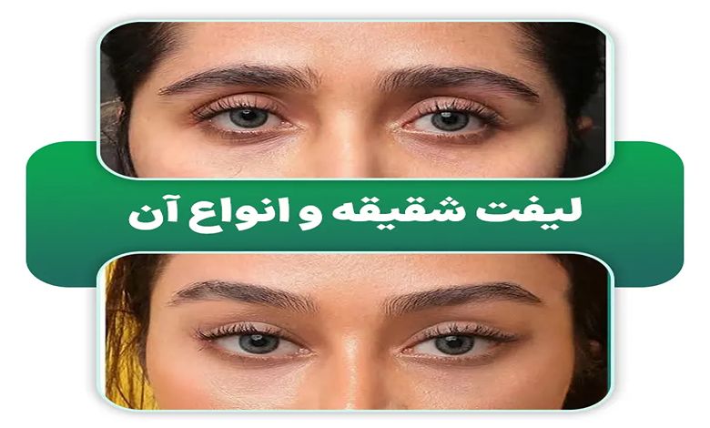 لیفت شقیقه با فیلر