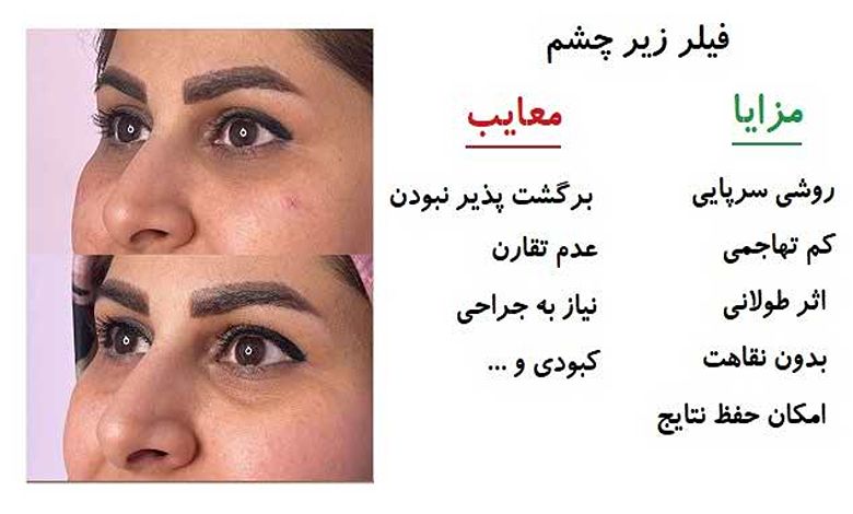 بهترین فیلر پایین چشم