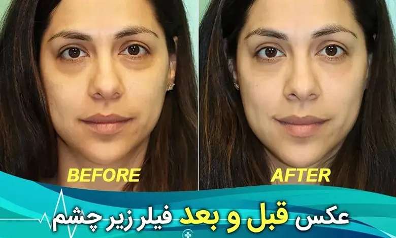 آیا فیلر زیر چشم باعث کوچک شدن چشم میشود ؟ عکس قبل و بعد از تزریق فیلر زیر چشم